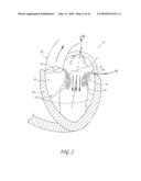 PERCUTANEOUS TRANSVALVULAR INTRANNULAR BAND FOR MITRAL VALVE REPAIR diagram and image