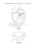 PERCUTANEOUS TRANSVALVULAR INTRANNULAR BAND FOR MITRAL VALVE REPAIR diagram and image