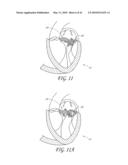 PERCUTANEOUS TRANSVALVULAR INTRANNULAR BAND FOR MITRAL VALVE REPAIR diagram and image