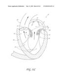 PERCUTANEOUS TRANSVALVULAR INTRANNULAR BAND FOR MITRAL VALVE REPAIR diagram and image