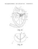 PERCUTANEOUS TRANSVALVULAR INTRANNULAR BAND FOR MITRAL VALVE REPAIR diagram and image