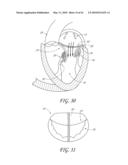 PERCUTANEOUS TRANSVALVULAR INTRANNULAR BAND FOR MITRAL VALVE REPAIR diagram and image