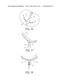 PERCUTANEOUS TRANSVALVULAR INTRANNULAR BAND FOR MITRAL VALVE REPAIR diagram and image