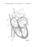 PERCUTANEOUS TRANSVALVULAR INTRANNULAR BAND FOR MITRAL VALVE REPAIR diagram and image