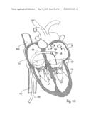 PERCUTANEOUS TRANSVALVULAR INTRANNULAR BAND FOR MITRAL VALVE REPAIR diagram and image