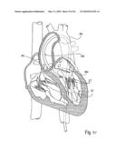 PERCUTANEOUS TRANSVALVULAR INTRANNULAR BAND FOR MITRAL VALVE REPAIR diagram and image