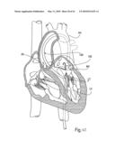 PERCUTANEOUS TRANSVALVULAR INTRANNULAR BAND FOR MITRAL VALVE REPAIR diagram and image