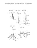 PERCUTANEOUS TRANSVALVULAR INTRANNULAR BAND FOR MITRAL VALVE REPAIR diagram and image