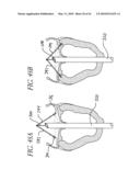 PERCUTANEOUS TRANSVALVULAR INTRANNULAR BAND FOR MITRAL VALVE REPAIR diagram and image