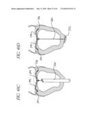 PERCUTANEOUS TRANSVALVULAR INTRANNULAR BAND FOR MITRAL VALVE REPAIR diagram and image