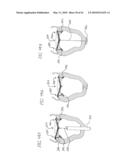 PERCUTANEOUS TRANSVALVULAR INTRANNULAR BAND FOR MITRAL VALVE REPAIR diagram and image