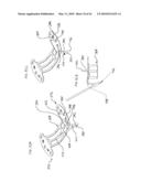 PERCUTANEOUS TRANSVALVULAR INTRANNULAR BAND FOR MITRAL VALVE REPAIR diagram and image