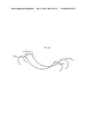 PERCUTANEOUS TRANSVALVULAR INTRANNULAR BAND FOR MITRAL VALVE REPAIR diagram and image