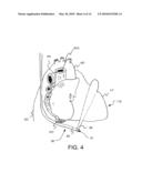 TRANSESOPHAGEAL ULTRASOUND USING A NARROW PROBE diagram and image