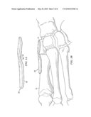 FIXATION PLATE FOR USE IN THE LAPIDUS APPROACH diagram and image