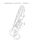 FIXATION PLATE FOR USE IN THE LAPIDUS APPROACH diagram and image