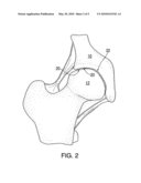 DEVICE & METHOD FOR RESTORING JOINTS WITH ARTIFICIAL CARTILAGE diagram and image