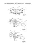 EXTRA DISCAL INTERVERTEBRAL STABILIZATION ELEMENT FOR ARTHRODESIS diagram and image