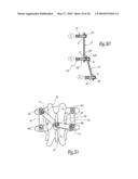 EXTRA DISCAL INTERVERTEBRAL STABILIZATION ELEMENT FOR ARTHRODESIS diagram and image