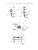 EXTRA DISCAL INTERVERTEBRAL STABILIZATION ELEMENT FOR ARTHRODESIS diagram and image