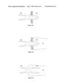 OSTEOSYNTHESIS DEVICE diagram and image