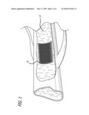Endoluminal Implants For Bioactive Material Delivery diagram and image