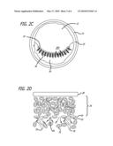 Endoluminal Implants For Bioactive Material Delivery diagram and image