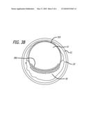 Endoluminal Implants For Bioactive Material Delivery diagram and image