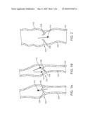 One-Way valve Prosthesis for Percutaneous Placement Within the Venous System diagram and image