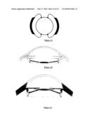 HAPTIC DEVICES FOR INTRAOCULAR LENS diagram and image