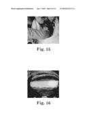 SYSTEM AND METHOD FOR REDUCING ENVIRONMENTAL CREMATORIAL RELEASE OF MERCURY FROM MERCURY-CONTAINING DENTAL AMALGAM diagram and image