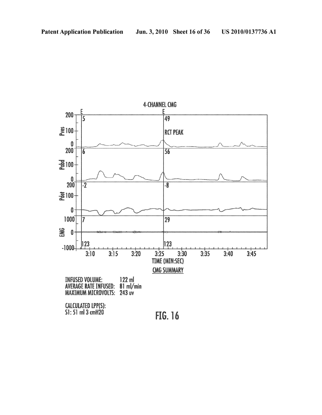 INVOLUNTARY CONTRACTION INDUCED PRESSURE AS A MEDICAL DIAGNOSTIC TOOL USING INVOLUNTARY REFLEX COUGH TEST - diagram, schematic, and image 17