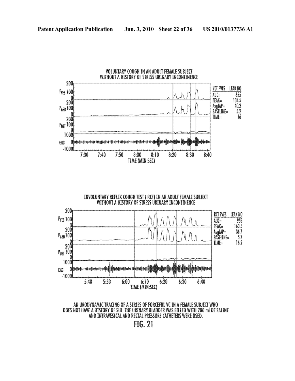 INVOLUNTARY CONTRACTION INDUCED PRESSURE AS A MEDICAL DIAGNOSTIC TOOL USING INVOLUNTARY REFLEX COUGH TEST - diagram, schematic, and image 23