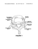 Injection of fibrin sealant including an anesthetic in spinal applications diagram and image