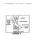 Injection of fibrin sealant including an anesthetic in spinal applications diagram and image