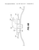 System and Method for Mechanical Closure of Wounds diagram and image