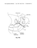 METHODS AND DEVICES FOR APPLYING ENERGY TO BODILY TISSUES diagram and image