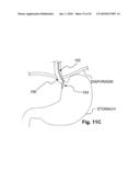 METHODS AND DEVICES FOR APPLYING ENERGY TO BODILY TISSUES diagram and image