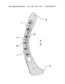 METHOD AND SYSTEM FOR THE INTRAMEDULLARY FIXATION OF A FRACTURED BONE diagram and image