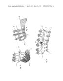 METHOD AND SYSTEM FOR THE INTRAMEDULLARY FIXATION OF A FRACTURED BONE diagram and image