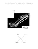 SYSTEMS AND METHODS FOR JOINT REPLACEMENT diagram and image