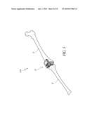 SYSTEMS AND METHODS FOR JOINT REPLACEMENT diagram and image