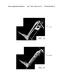 SYSTEMS AND METHODS FOR JOINT REPLACEMENT diagram and image