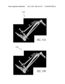 SYSTEMS AND METHODS FOR JOINT REPLACEMENT diagram and image