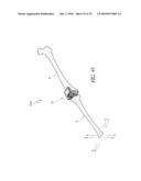 SYSTEMS AND METHODS FOR JOINT REPLACEMENT diagram and image