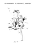 SYSTEMS AND METHODS FOR JOINT REPLACEMENT diagram and image