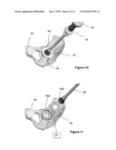 ACETABULAR LINER INSERTER GUIDE diagram and image