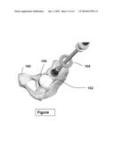 ACETABULAR LINER INSERTER GUIDE diagram and image