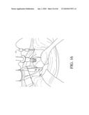 HIP SURGERY SYSTEMS AND METHODS diagram and image