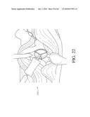 HIP SURGERY SYSTEMS AND METHODS diagram and image